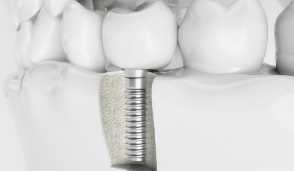 How Much Are Dental Implants? (Price Chart)