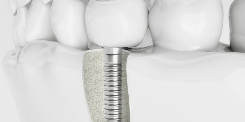 How Much Are Dental Implants? (Price Chart)