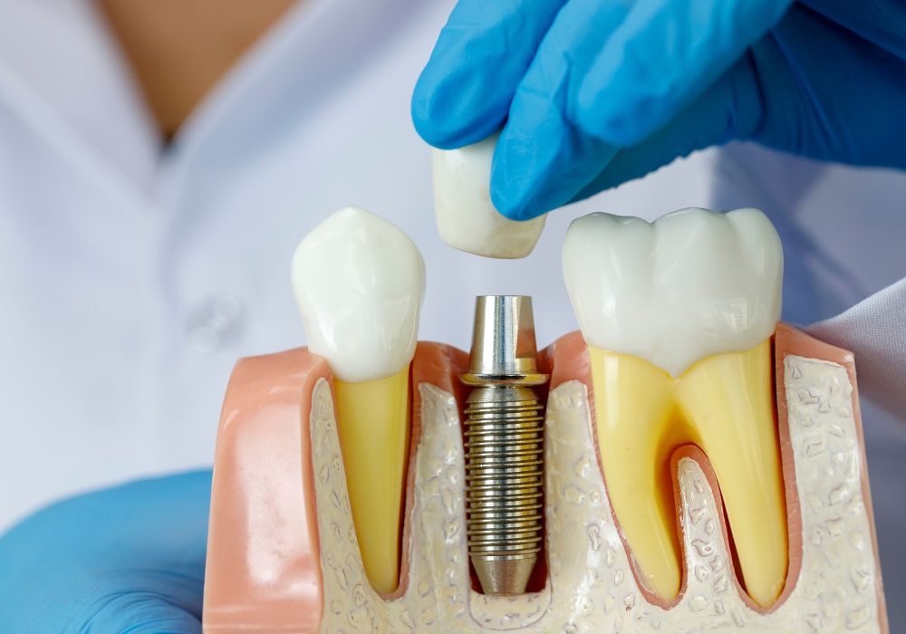 Dental Implants