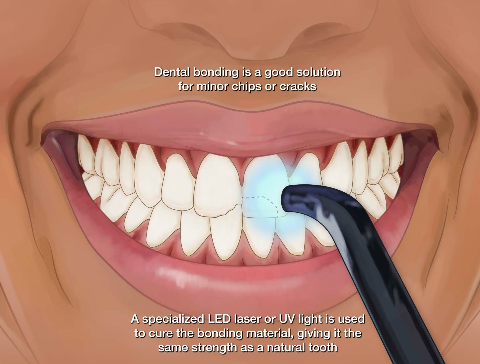 How Long Does Dental Bonding Last?