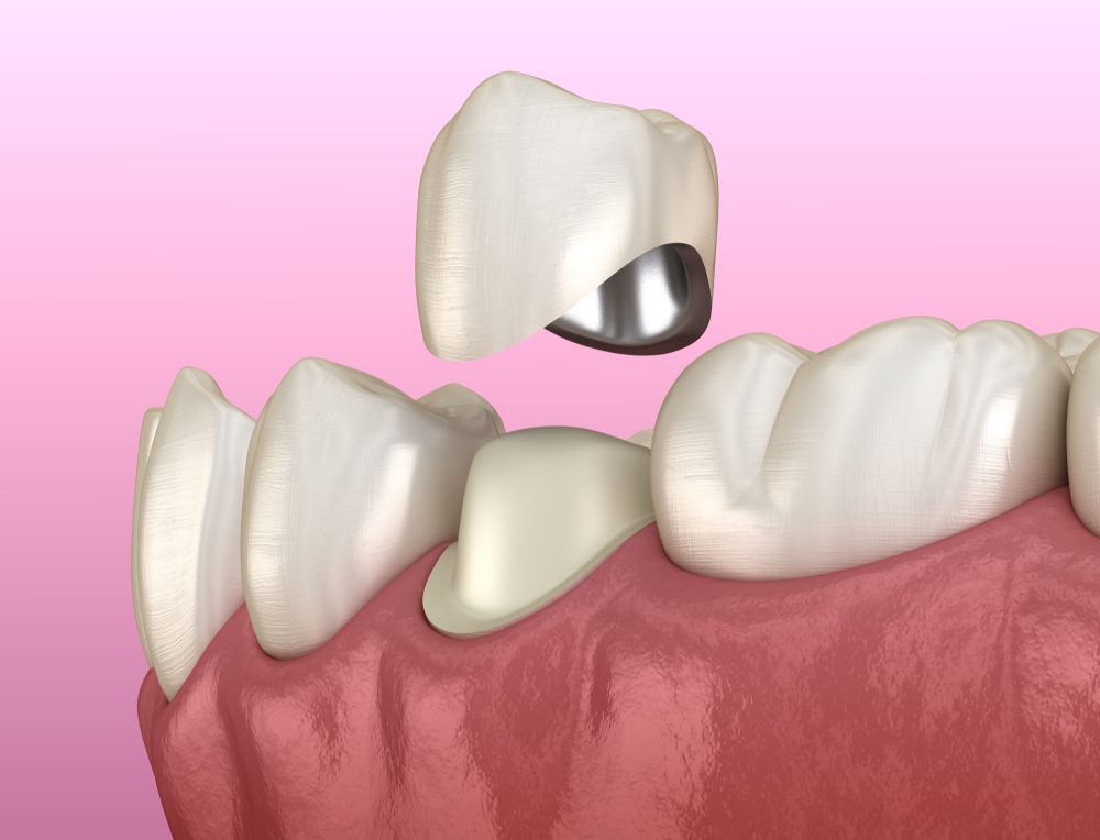 Porcelain Fused to Metal Crowns