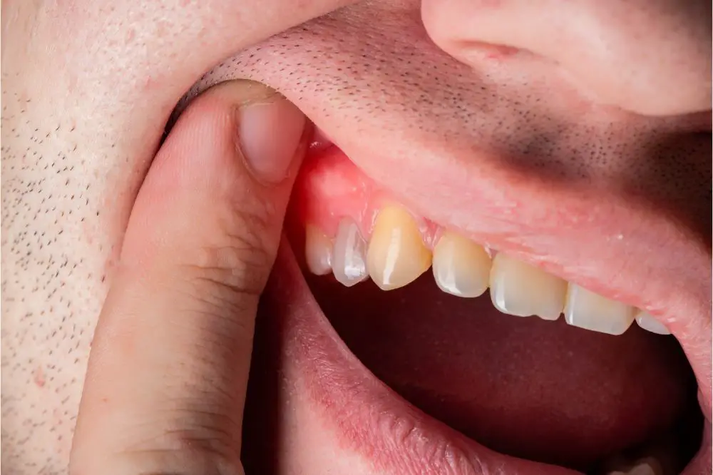 What to Do if a Dental Abscess Bursts on Its Own?