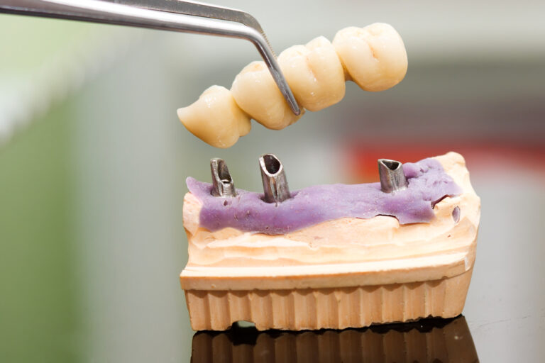 How Much Does A Dental Bridge Cost? (Types & Materials)