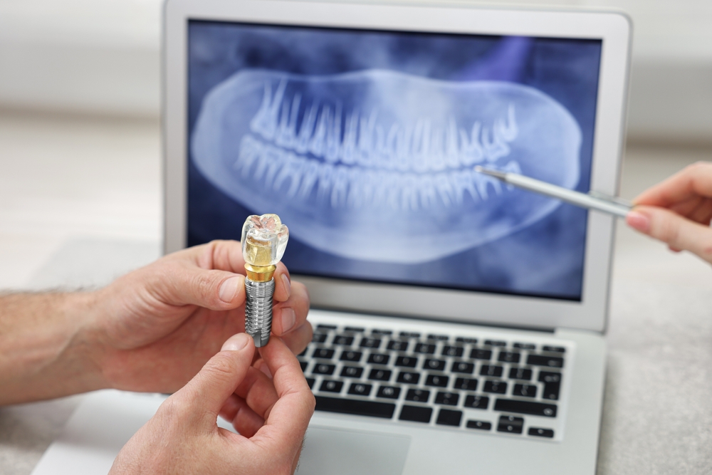 how much does it cost to get a full mouth of dental implants?