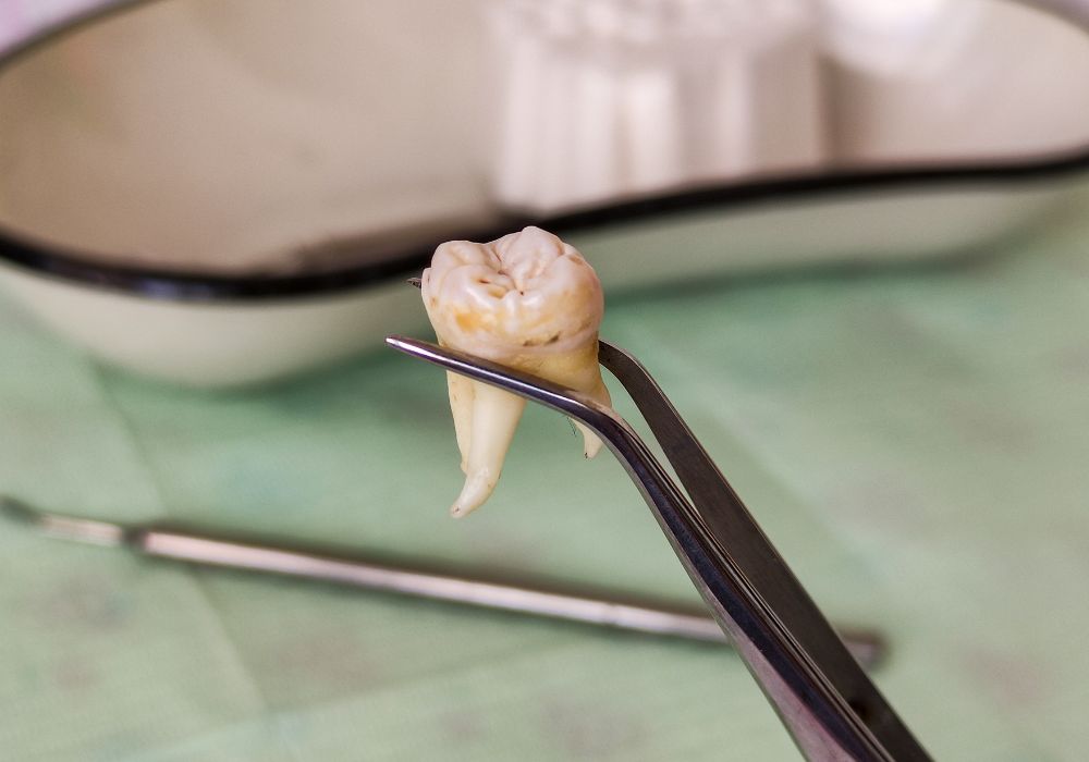 When Can I Eat Crunchy Food After Wisdom Tooth Removal?