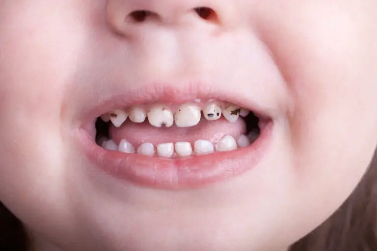 Can rotten baby teeth be saved? (Treatments & Preventions)